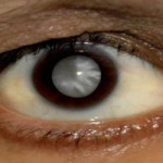 Ratusan Penderita Katarak di Lampura Dapat Bantuan Operasi Gratis