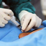 Tiga Orang Meninggal, Penggunaan Obat Bius Bupivacaine Dihentikan Sementara